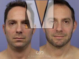 Dermal Fillers