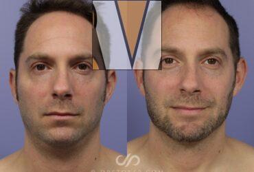 Dermal Fillers