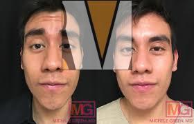 Dermal fillers