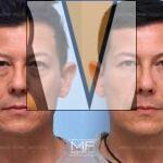 Juvederm