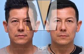 Juvederm