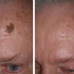 A Complete Guide to Mole Removal Procedures in London
