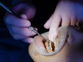 Tips for Braces and Aligners Maintenance
