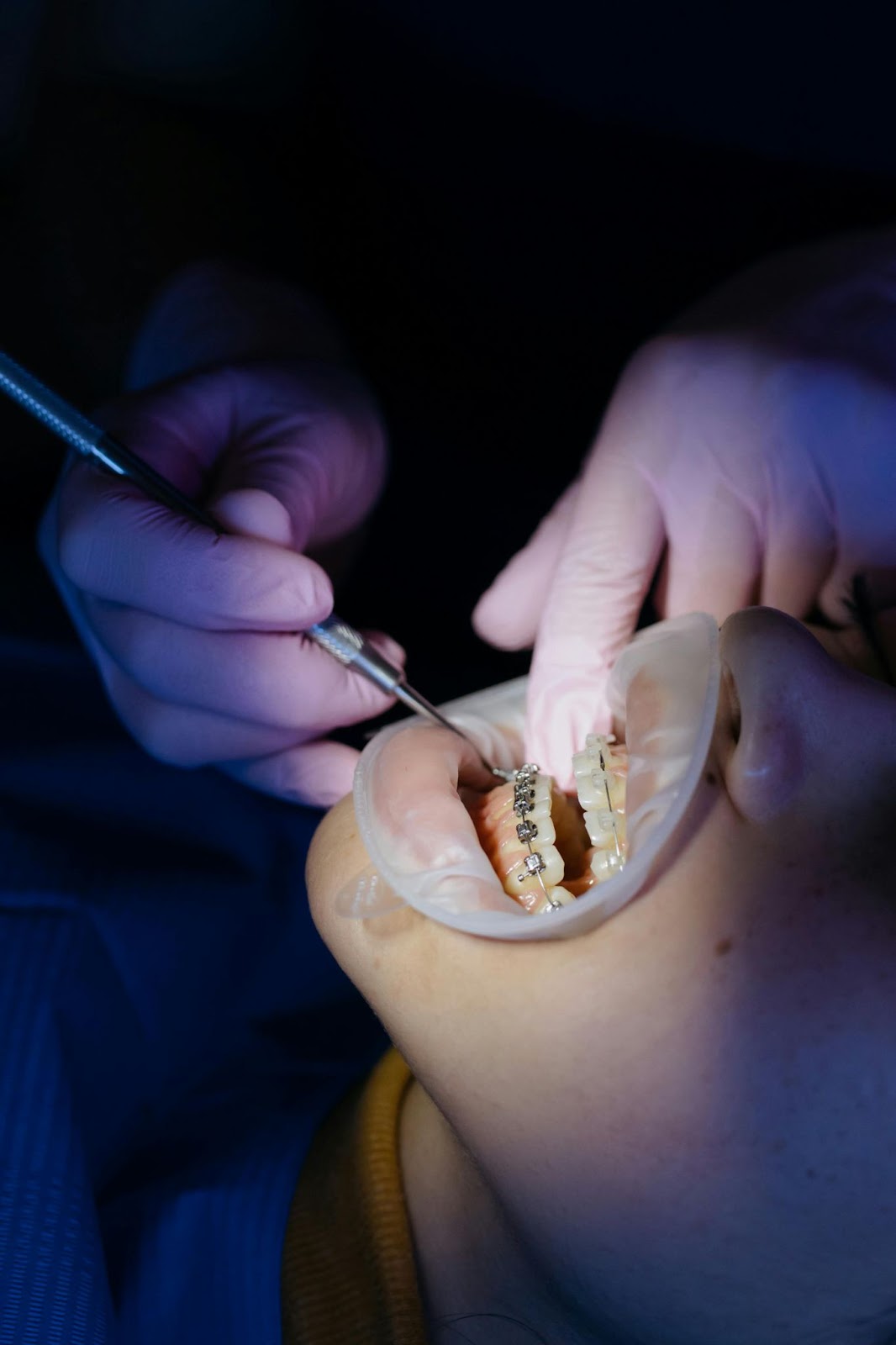 Tips for Braces and Aligners Maintenance