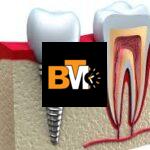 8 signs that you need dental implants