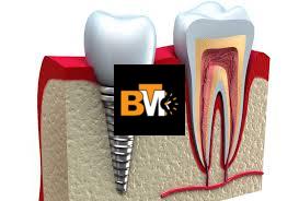 8 signs that you need dental implants
