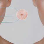 Moles Removal
