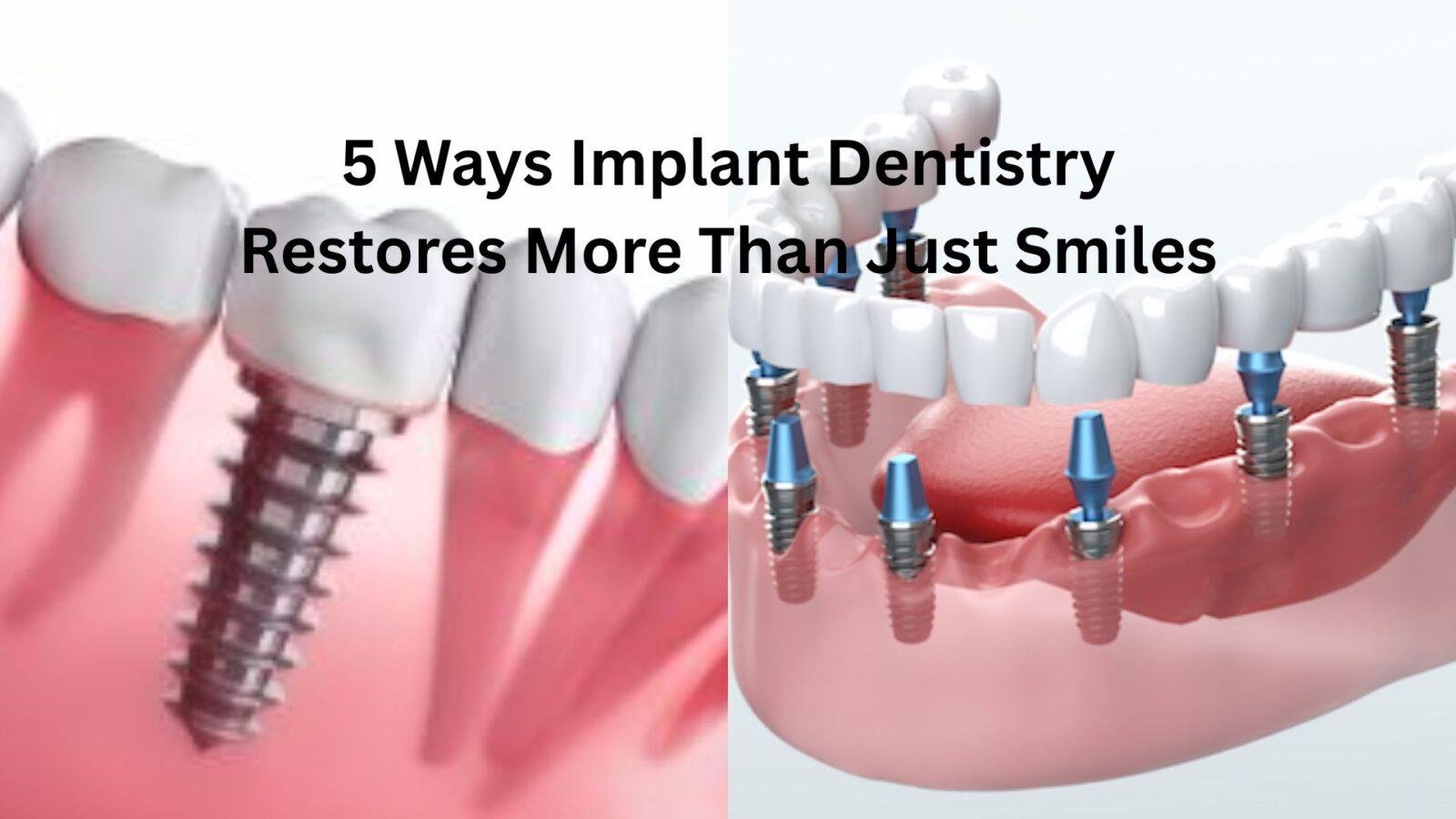 5 Ways Implant Dentistry Restores More Than Just Smiles